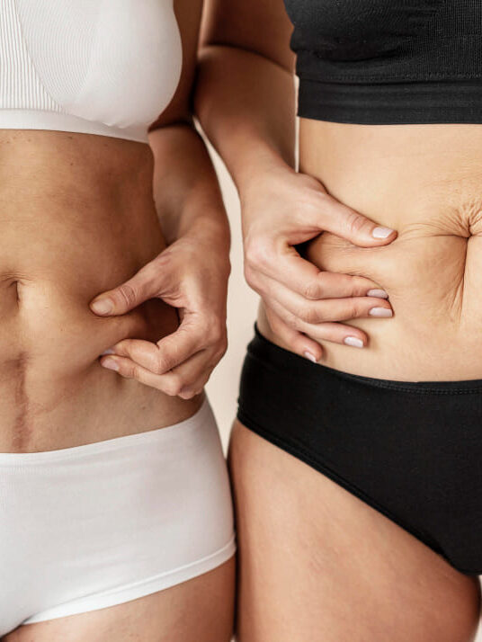 Flacidez abdomen